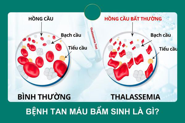Thalassemia trong thai kỳ